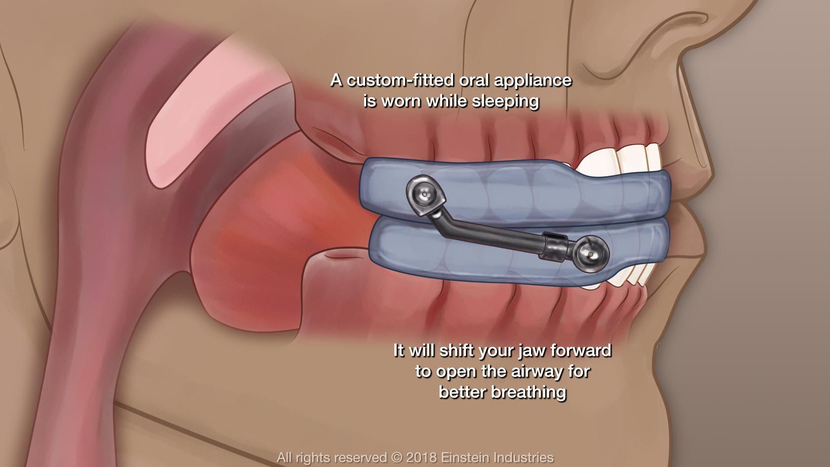 Diagram that shows how an oral appliance for sleep apnea works. It reads: "A custom-fitted oral appliance is worn while sleeping" and "It will shift your jaw forward to open the airway for better breathing"